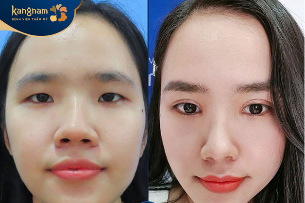 Khách hàng trước và sau khi cắt cánh mũi tại Kangnam
