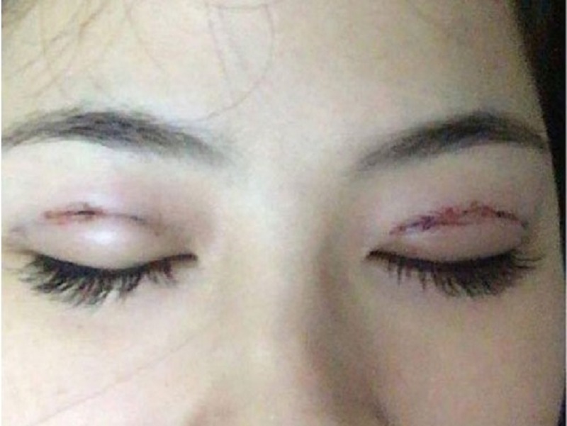 Mí mắt có dấu hiệu để lại sẹo