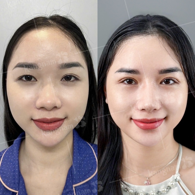 Bệnh viện Thẩm mỹ Kangnam ứng dụng kỹ thuật cắt mí hiện đại, giúp khách hàng giảm thiểu sưng tấy