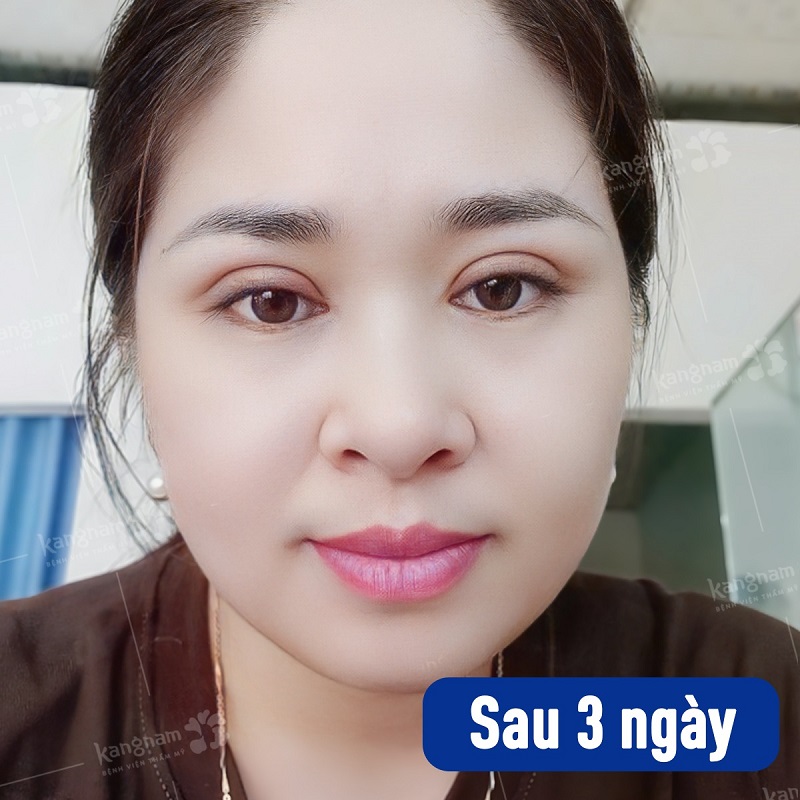 Sau 3 ngày mí mắt vẫn còn sưng tấy