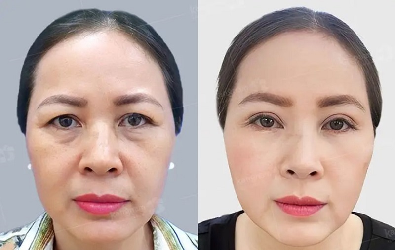 Mí dưới cân đối hài hòa với khuôn mặt