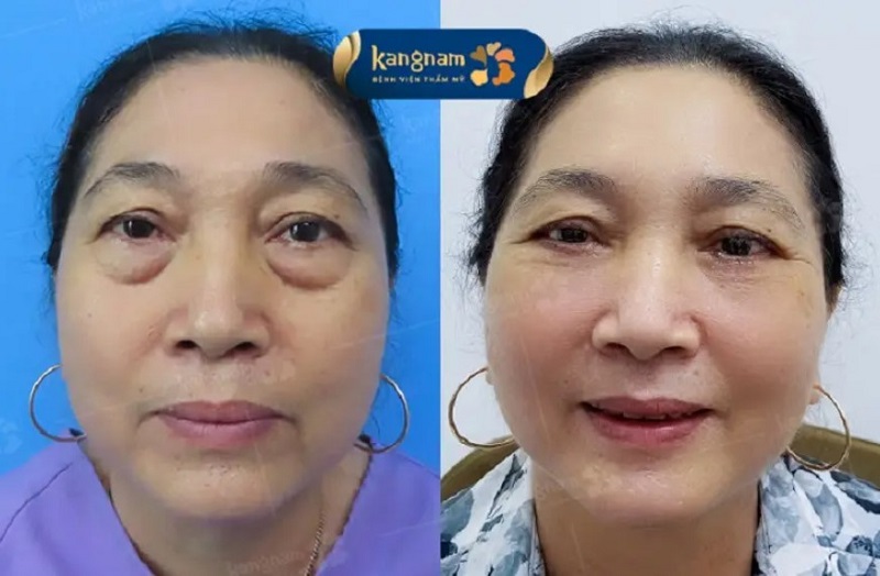 Cắt mí dưới tại Kangnam dùng chỉ khâu thẩm mỹ siêu mảnh