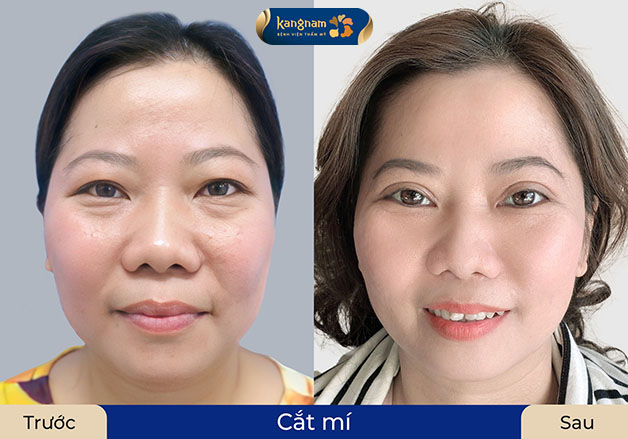 Cắt mí loại bỏ da chùng, giúp đôi mắt trẻ trung