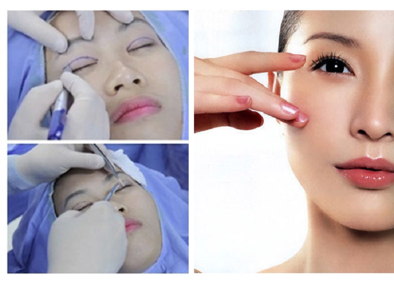 Bác sĩ thao tác cắt mí không đúng kỹ thuật