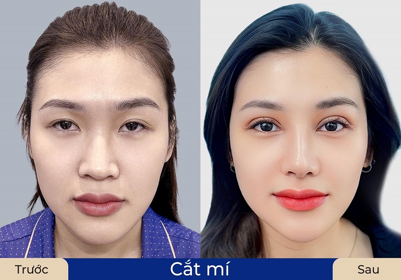Khách hàng thực hiện cắt mí tại Kangnam giúp đôi mắt cân đối, tự nhiên