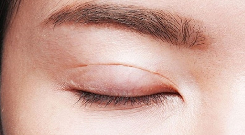 Vết thương có thể lại sẹo hoặc thậm sạm sau khi ăn thịt bò