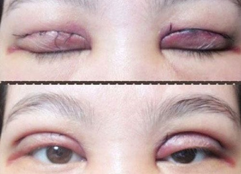 Cắt mí không đúng cách sẽ khiến mí mắt bị trợn