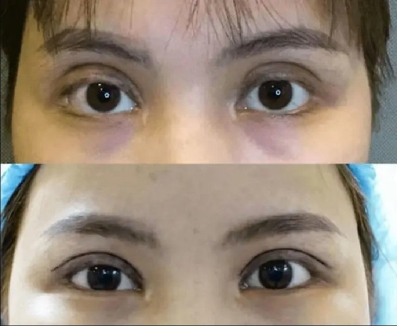 Cắt mí bị trợn do kỹ thuật thực hiện không đúng
