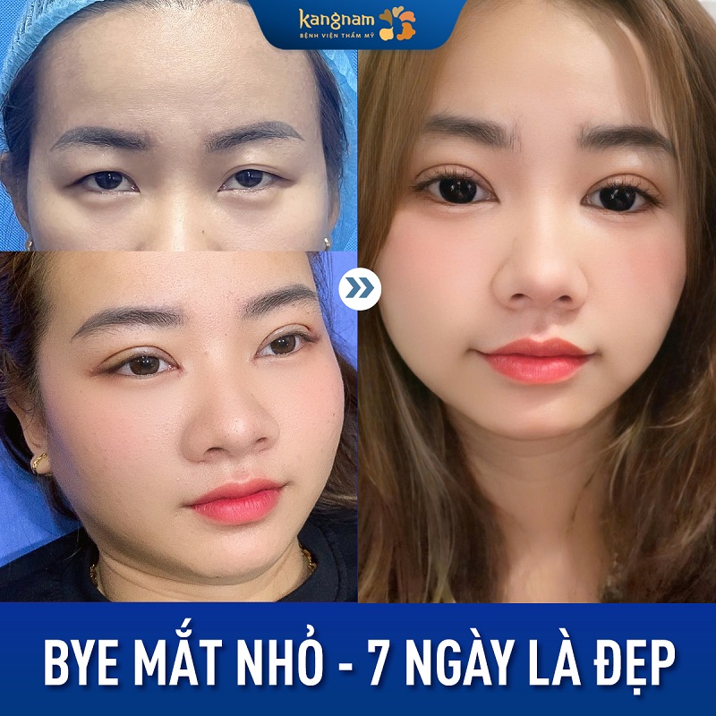 Cắt mí giúp gương mặt tươi trẻ, rạng rỡ hơn