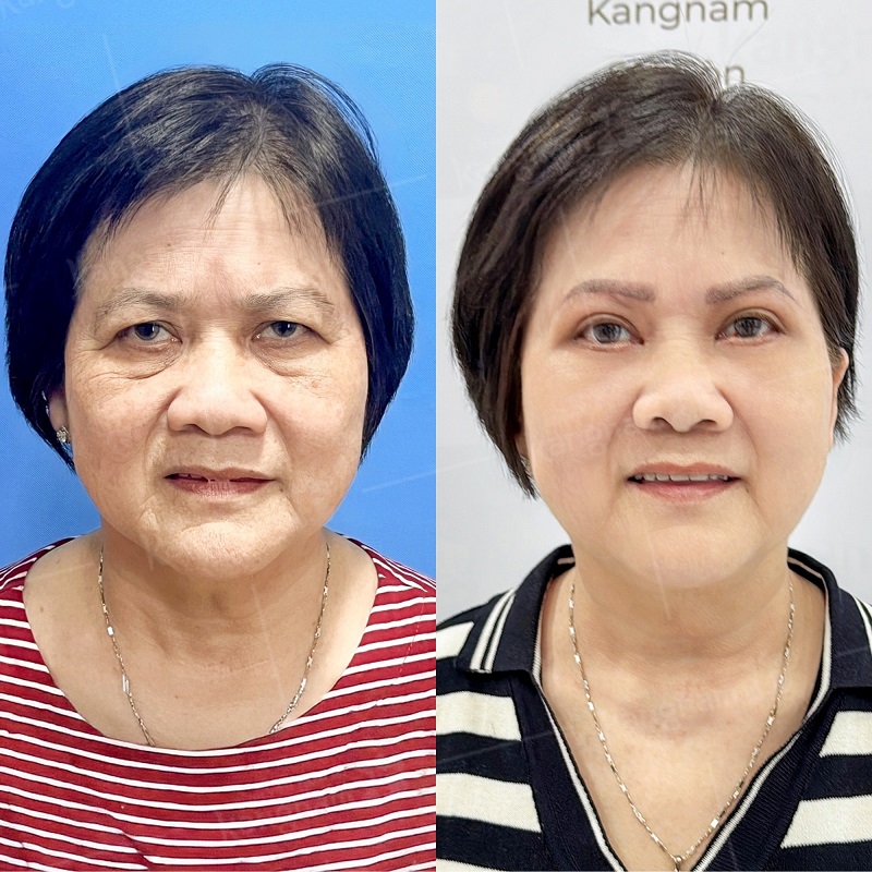 Cắt mí giúp cải thiện tầm nhìn và tính thẩm mỹ