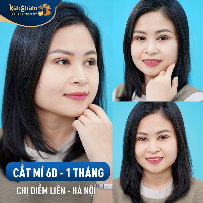 Khi cắt mí giúp thay đổi khuyết điểm của mí mắt
