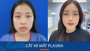 Giải mã phương pháp cắt mí mắt Plasma: “Cứu tinh” cho đôi mắt mí lót, sụp mí