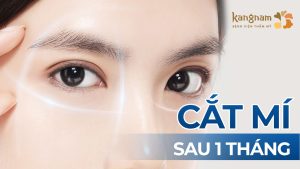 Cắt mí sau 1 tháng: Mắt đẹp rạng ngời, không còn sưng bầm