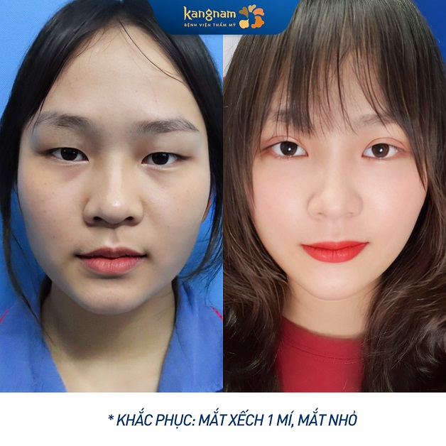 Kết quả cắt mí mắt sau 1 tháng tại Kangnam, bạn đã có thể trang điểm bình thường