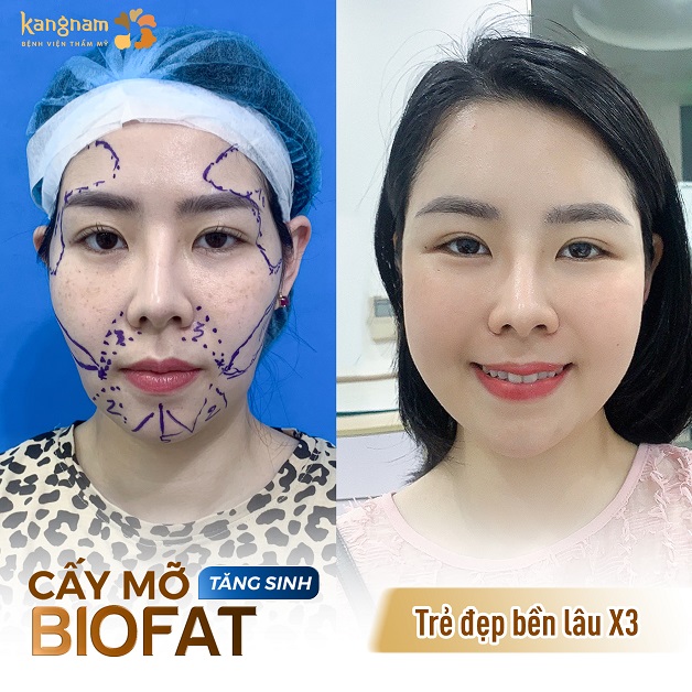 Cấy mỡ biofat tăng sinh mang lại vẻ đẹp bền lâu gấp 3 lần