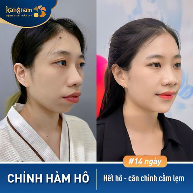 Trước và sau khi chỉnh hàm hô, gương mặt cân đối, hài hòa