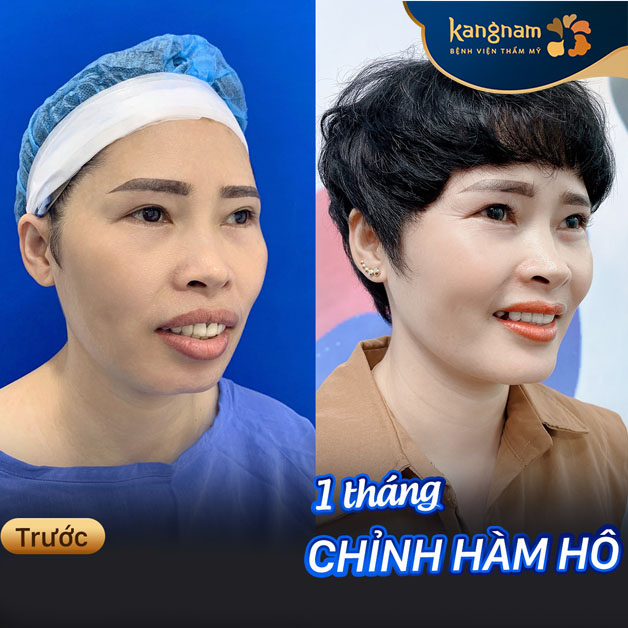 Chỉnh hàm hô cải thiện cả về thẩm mỹ và sức khỏe