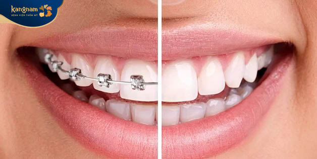 Phương pháp niềng răng, chỉnh nha