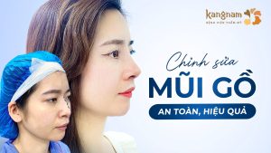 Bí quyết sở hữu dáng mũi thanh tú: Chỉnh sửa mũi gồ an toàn, hiệu quả