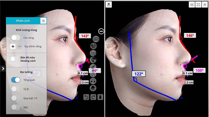 Áp dụng công nghệ AI-Face Design tiên tiến để xem trước kết quả nâng mũi