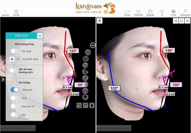 Sử dụng AI Face Design khi nâng mũi 6D Surgiform