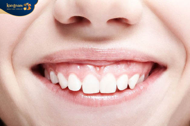 Cười hở lợi là tình trạng khi cười mà lợi ở chân răng bị lộ ra ngoài