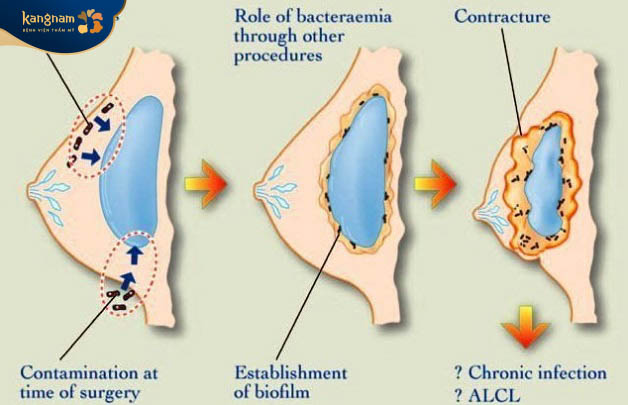Vi khuẩn xâm nhập gây co thắt bao xơ túi ngực