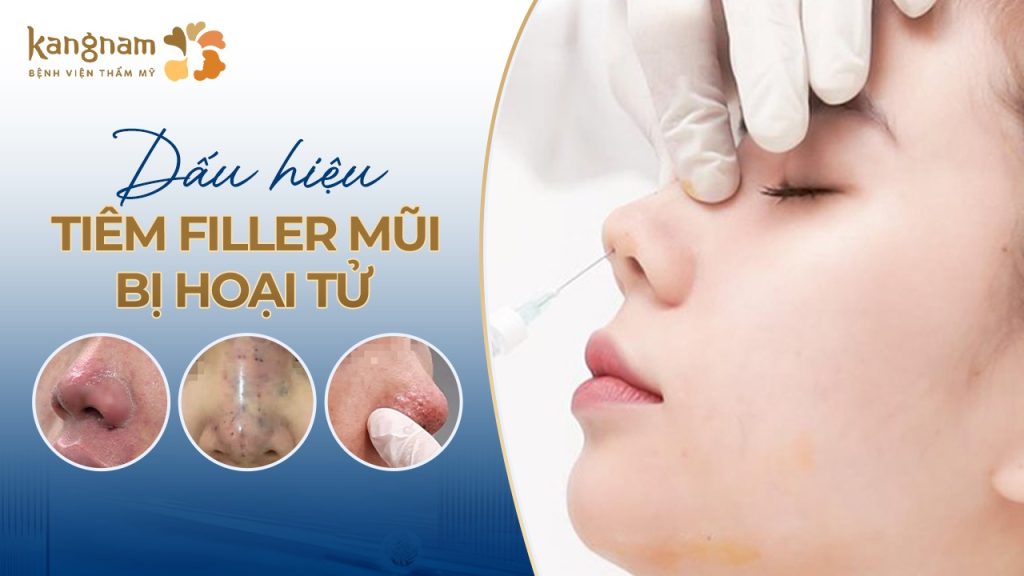 Mũi tiêm filler bị hoại tử: Nguy cơ tiềm ẩn và cách phòng tránh hiệu quả