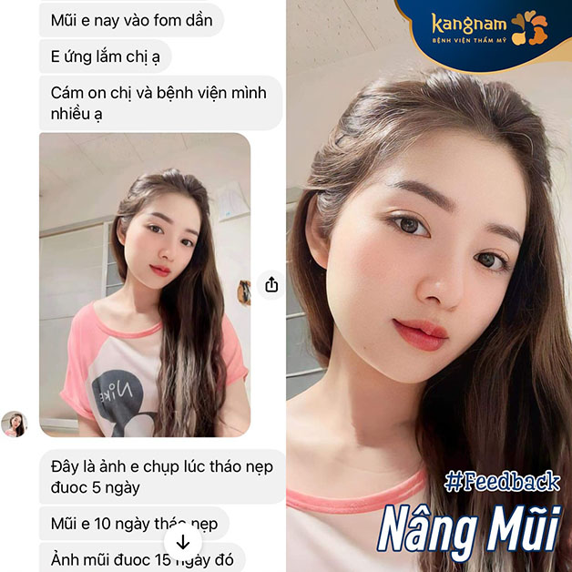 Mũi sau 5 ngày tháo nẹp đẹp tự nhiên