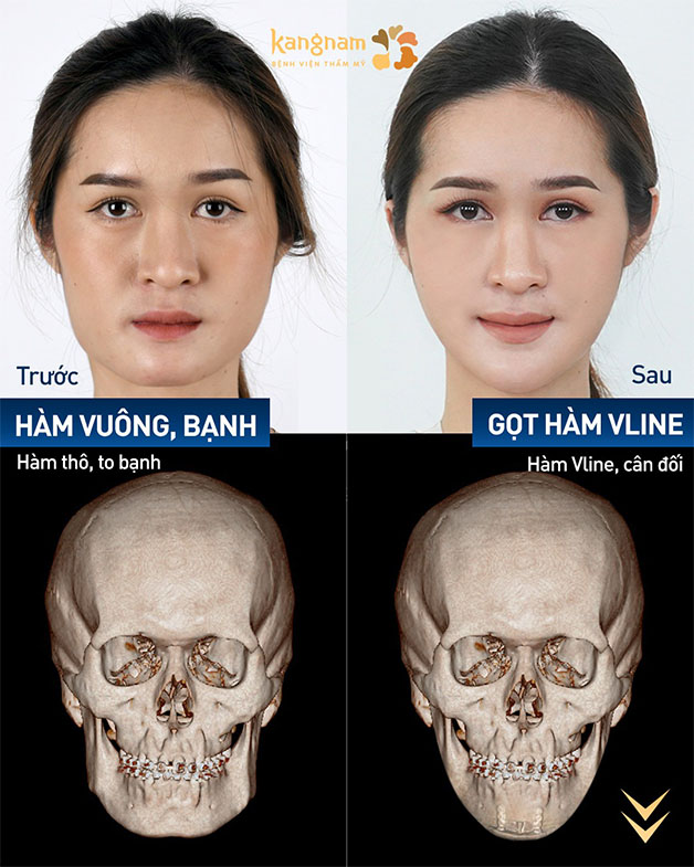 Gọt cằm có kết quả vĩnh viễn