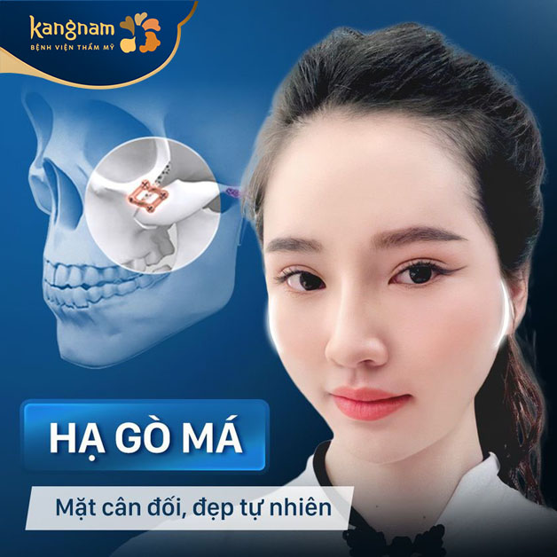 Hạ gò má 3D tại Kangnam mang lại gương mặt cân đối, đẹp tự nhiên