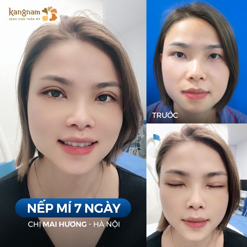 Cắt mí hết sẹo sau 3-6 tháng