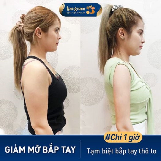 Hút mỡ bắp tay duy trì kết quả vĩnh viễn