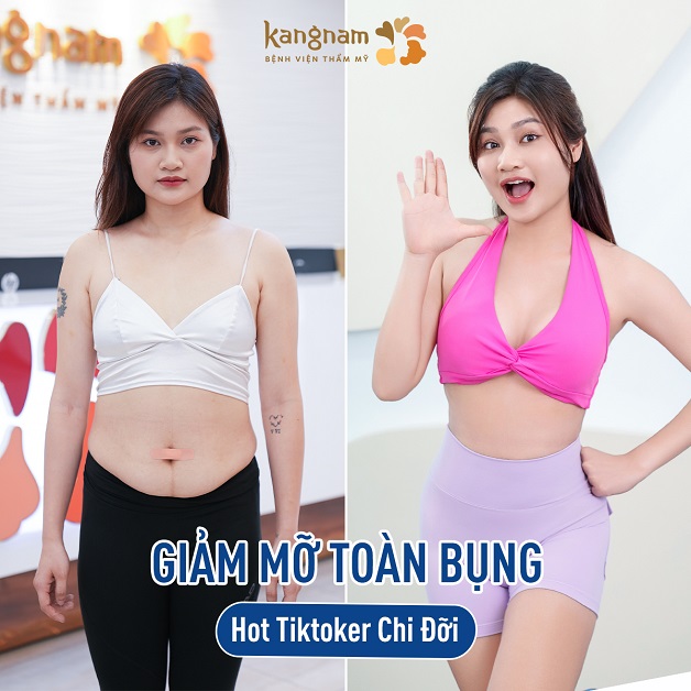 Hot Tiktoker Chi Đỡi tự tin khoe vóc dáng mới thon gọn sau khi trải nghiệm dịch vụ giảm mỡ Lipo 360