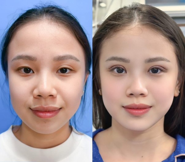 Mắt hai mí rõ nét, hài hòa và phù hợp với tổng thể