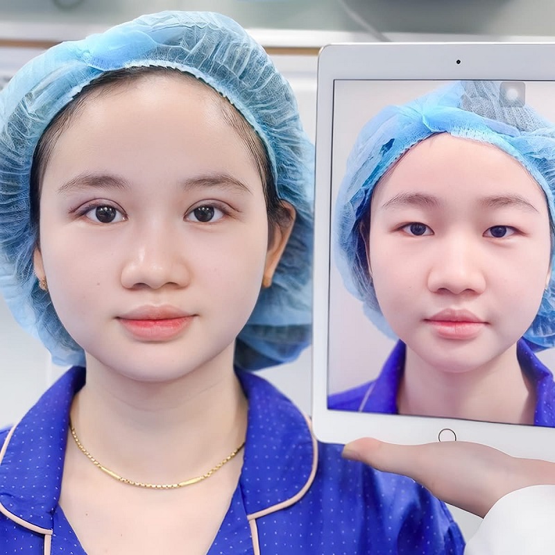 Mắt hai mí cân đối, rõ nét và tự nhiên