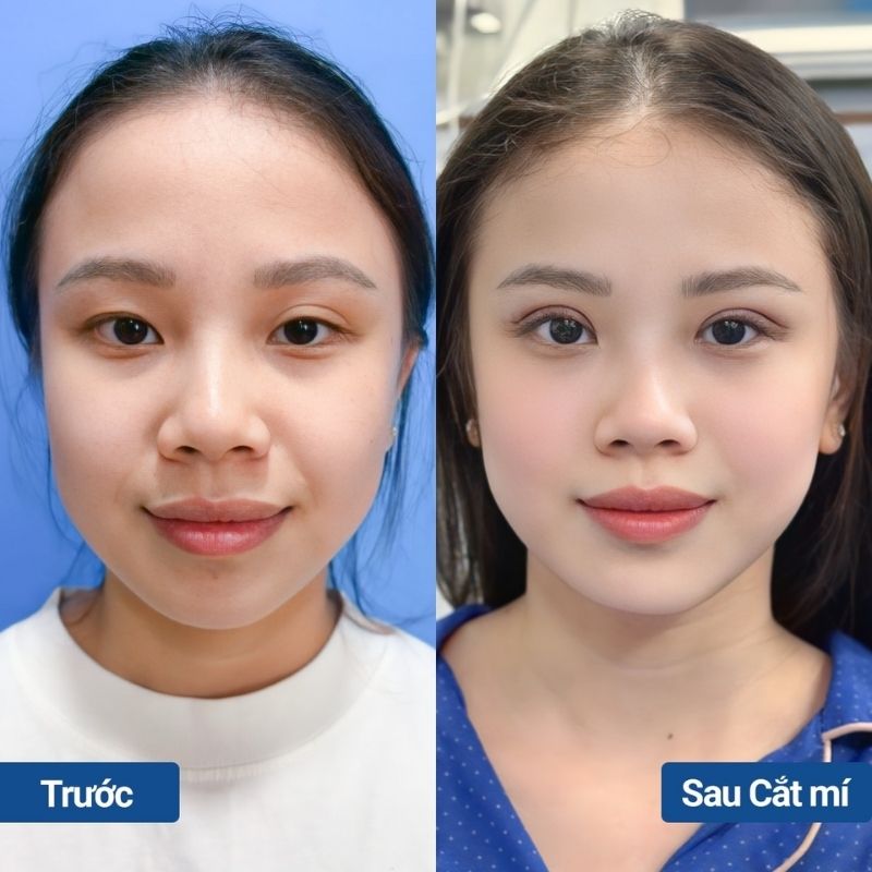 Nếp mí cân đối, hài hòa