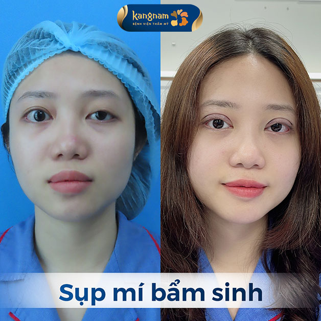 Một bên mắt một mí, một bên hai mí do di truyền