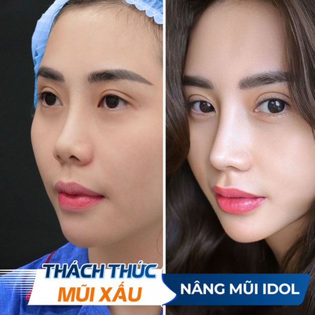 Xóa bỏ mũi hếch tự ti, sở hữu sống mũi cao, thon gọn