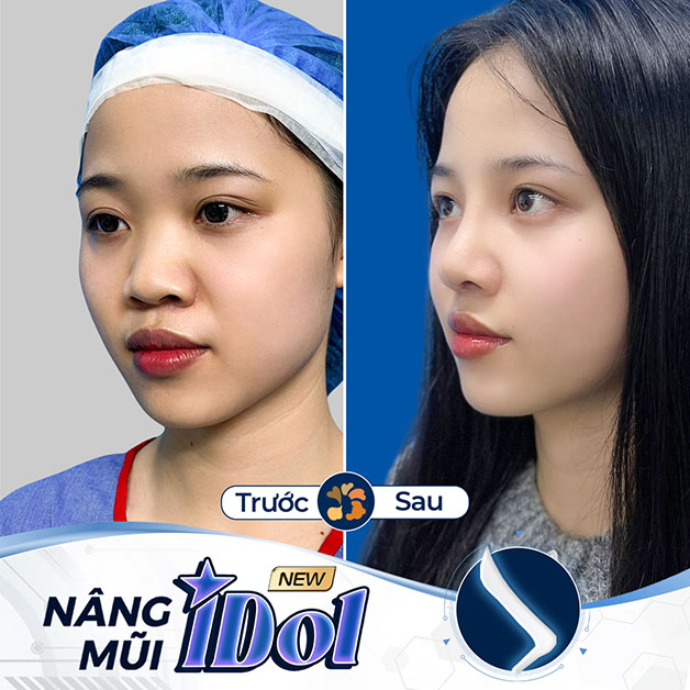 Diện mạo mới với dáng mũi hoàn hảo sau khi nâng mũi Idol