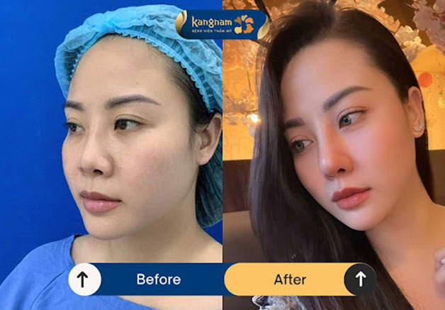 Chị Trang Lương gửi phản hồi sau 10 ngày nâng mũi Idol 