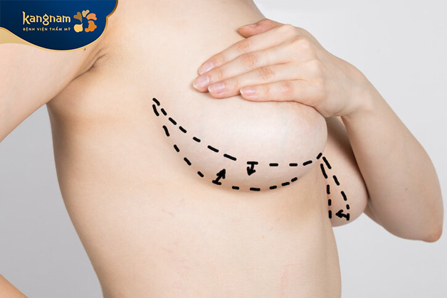 Kỹ thuật cắt ngực Double Incision