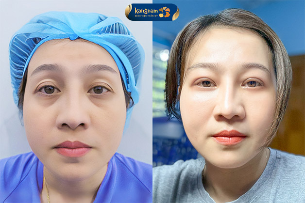 Cấy mỡ trẻ hóa vùng mắt