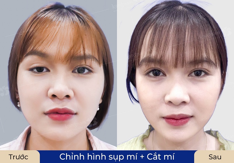 Cắt mí giúp tạo nếp mí mới cân đối, tự nhiên