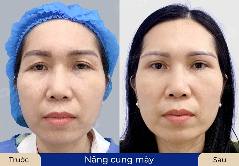 Nâng cung mày cũng giúp khắc phục hiện tượng sụp mí