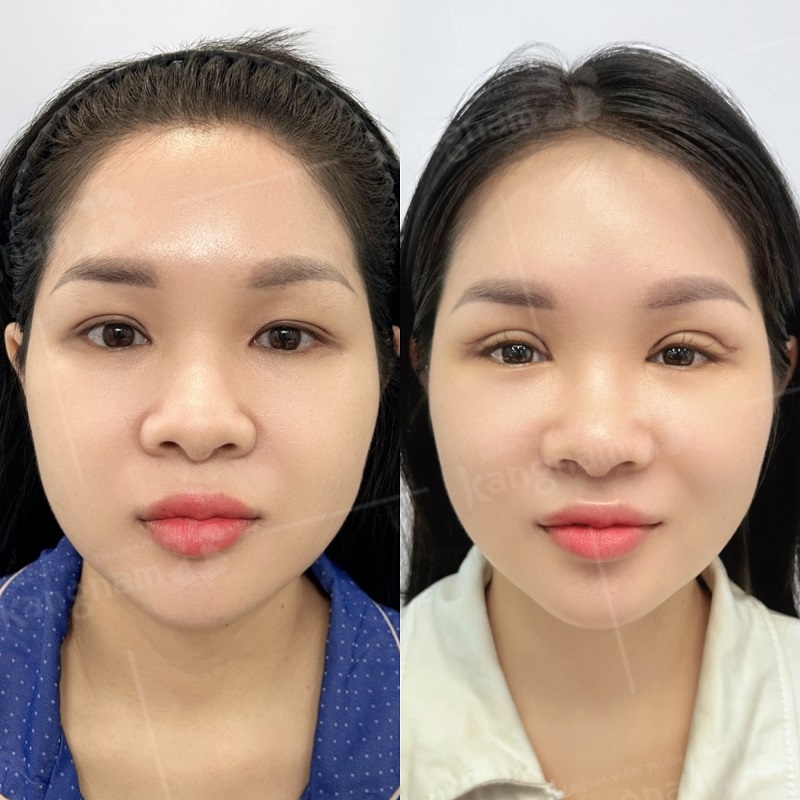 Khách hàng hài lòng với đôi mí mới sau cắt mí