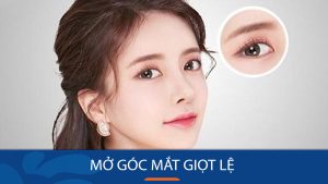 Mở Góc Mắt Giọt Lệ: Giải pháp hoàn hảo cho đôi mắt nhỏ, mí lót, mí sụp – Những điều cần biết