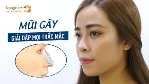 Mũi gãy: Giải đáp mọi thắc mắc về nguyên nhân, triệu chứng và cách điều trị