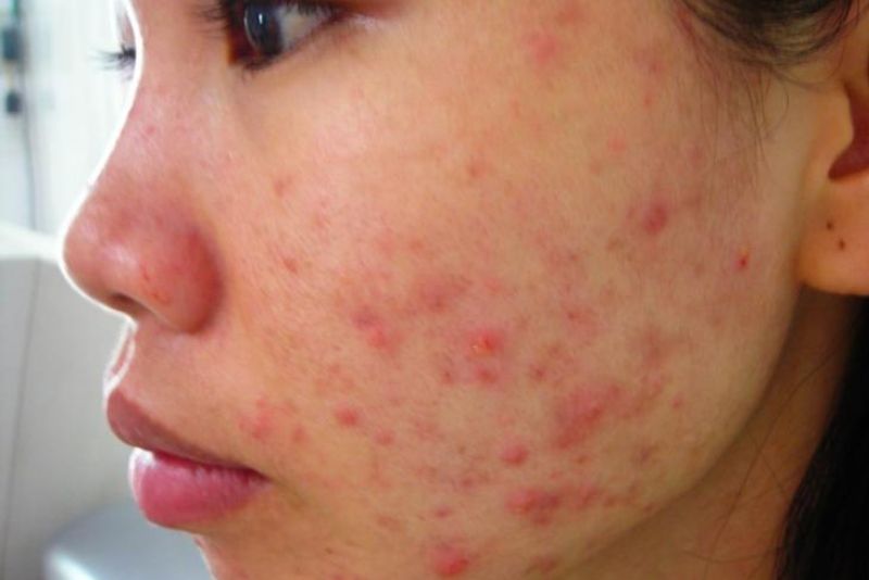 Hormone androgen tăng cao kích thích tuyến bã nhờn hoạt động mạnh