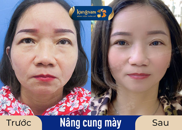 Nâng cung mày không để lại sẹo do bác sĩ chỉ rạch một đường nhỏ tại chân mày và dùng chỉ thẩm mỹ siêu mảnh để đóng vết thương